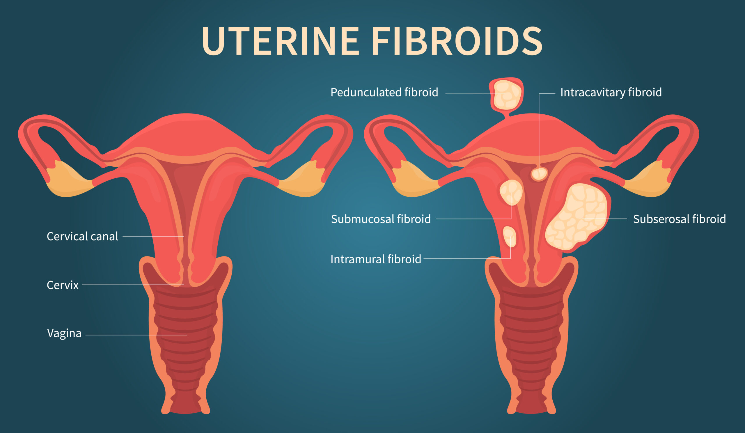 what types of uterine fibroids are there zenith firboids